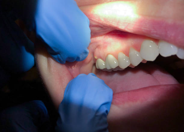 Best Emergency Tooth Extraction  in Wells Branch, TX